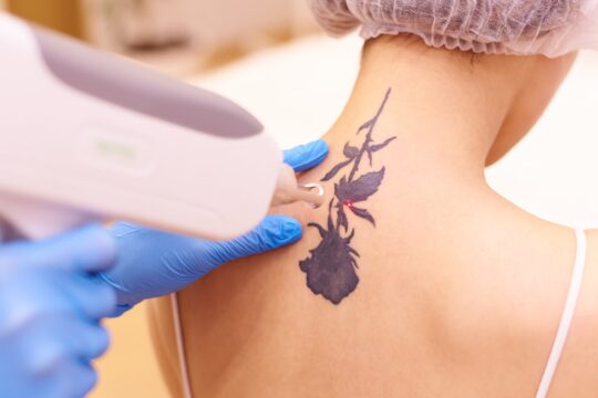 Jak działa laserowe usuwanie tatuażu?