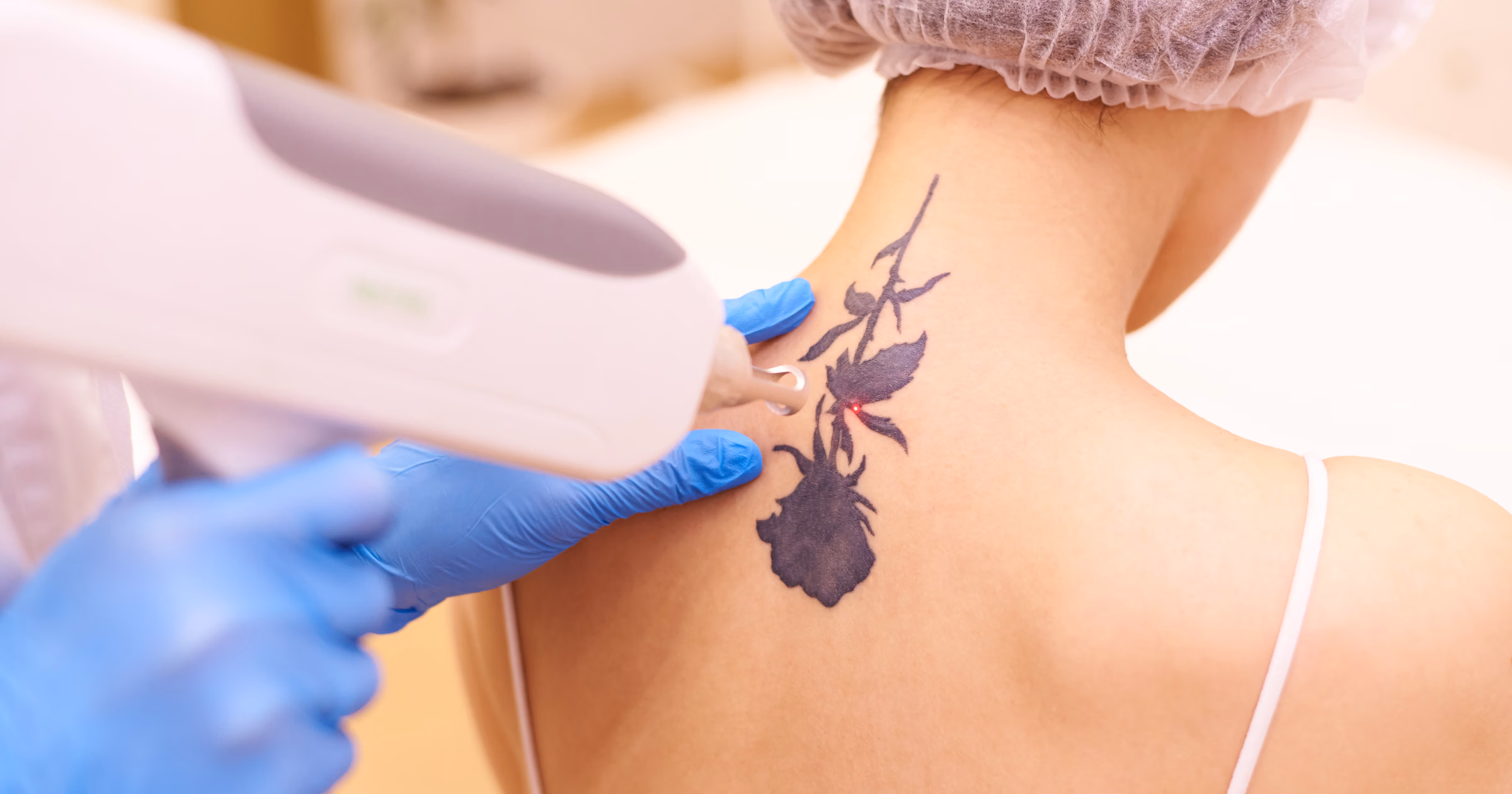 Jak działa laserowe usuwanie tatuażu?